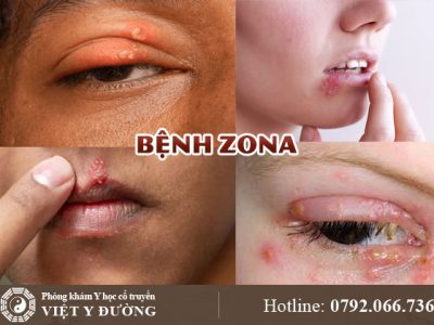 benh-zona-0