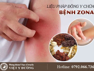 dieu-tri-zona